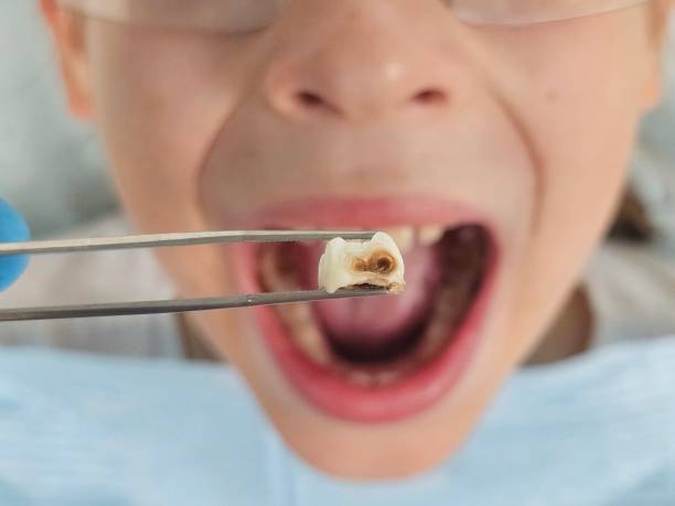 Best Emergency Wisdom Teeth Removal in Yountville, CA